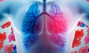 lung-1 lung-1 lung 1 Biologists unravel drug-resistance mechanism in tumor cells lung 1