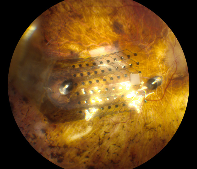 An Argus II device implanted over the eye’s macula. Credit: UCSF