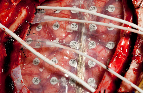 bioengineers measured electrical signals on the brain surface of four adults with epilepsy to understand how the brain processes speech. Their findings show our understanding of language may depend more heavily on vision than previously thought. Photo Credit: Department of Neurosurgery, University of Utah