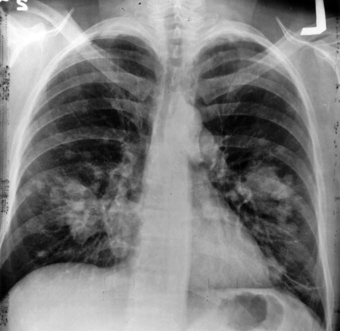 Lung Cancer Credit: Wikimedia