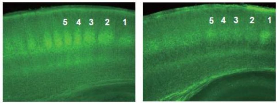 Suppression of thalamocortical projection by chronic administration of ?9-THC (cannabinoid, active ingredient of marijuana). Photomicrograph of cerebral cortex from transgenic mice expressing GFP in thalamocortical axons at postnatal day 7 (P7). (left) : Normal thalamocortical projections. In the middle layer (layer 4), blobs of GFP showing dense termination of thalamocortical axons can be seen (under number 1~5). (right): Thalamocortical projection at P7 from a mouse received chronic administration of ?9-THC (P2~7). Massive retraction of thalamocortical projections including middle layer (layer 4) can be observed. Credit: Osaka University