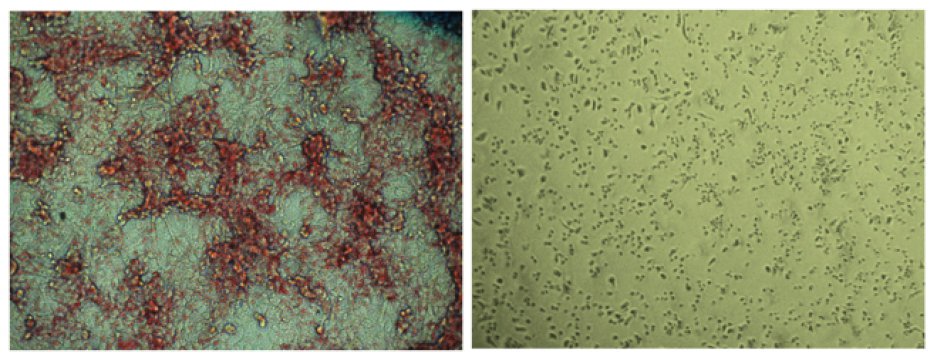 Salk Institute researchers and collaborators develop novel cancer treatment that halts fat synthesis in cells. Placebo-treated cells (left) have far more lipid (red) production compared to ND-646 treated cells (right). Credit: Image courtesy of Salk Institute