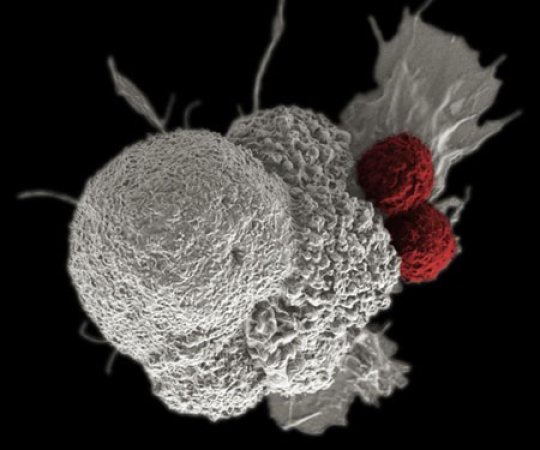 False-colored scanning electron micrograph depicts oral squamous cancer cell (white) being attacked by to T cells (red), part of the natural immune response. Photo Credit: National Cancer Institute