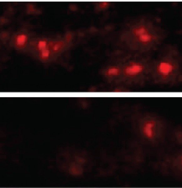 synuclein aggregates in the brain cells of mice with (top) and without (bottom) the LAG3 protein. Credit: Xiaobo Mao