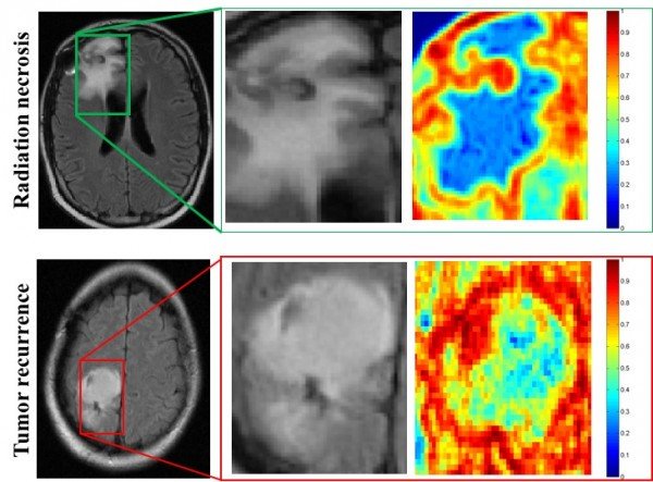 MRI scans of patients with radiation necrosis (above) and cancer recurrence (below) are shown in the left column. Close-ups in the center column show the regions are indistinguishable on routine scans. Radiomic descriptors unearth subtle differences showing radiation necrosis, in the upper right panel, has less heterogeneity, shown in blue, compared to cancer recurrence, in the lower right, which has a much higher degree of heterogeneity, shown in red. Photo Credit: Pallavi Tiwari