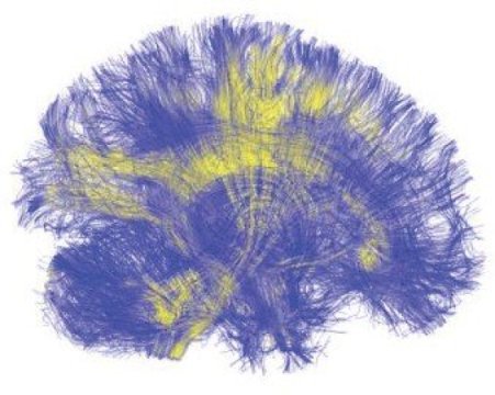 A visualization of the brain, reconstructed from MRI scans, shows tracts of white matter connecting different regions of the brain to one another. A new study that uses computational modeling to investigate brain stimulation finds that stimulating network hubs - areas of the brain that are strongly connected to other parts via white matter - results in the global activation of many brain regions. Credit: Jean Vettel, Army Research Laboratory/PLOS Computational Biology