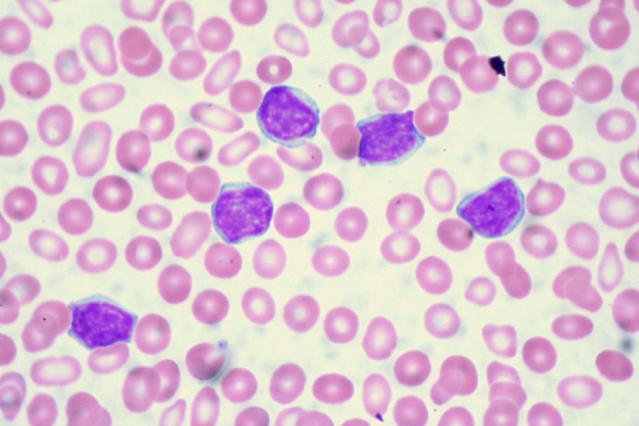 Researchers have developed a novel way to test tumors for drug susceptibility. They successfully tested this approach with a very aggressive type of brain cancer called glioblastoma multiforme and a type of blood cancer, pictured here in dark purple, known as acute lymphoblastic leukemia.