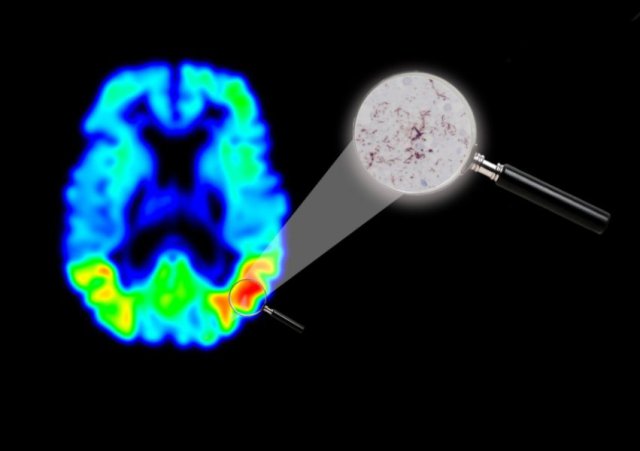 The brain of an Alzheimer's patient in a tau PET image. Red indicates the areas with the highest concentration of the tau protein. In the magnifying glass, a microscope enlargement showing the dark red streaks and islands of tau. Credit: Michael Schöll