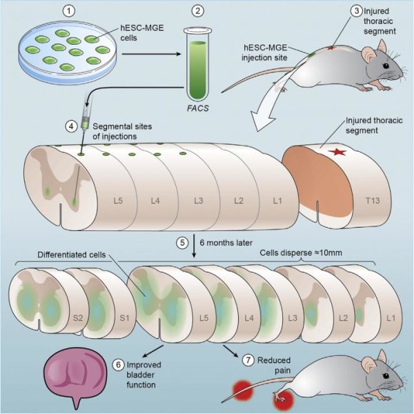 This visual abstract depicts the findings of Fandel et al., who show that transplanted human ESC-derived interneuron precursors in an injured mouse spinal cord integrate and differentiate into human GABAergic neurons and relieve injury-related symptoms, such as neurogenic bladder dysfunction and central neuropathic pain. Credit: Fandel et al./Cell Stem Cell 2016