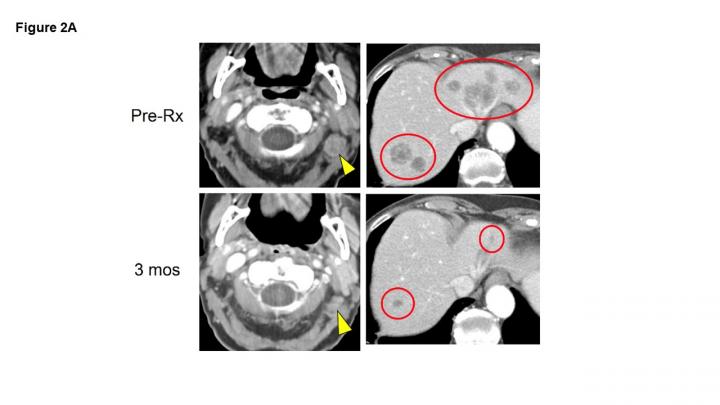 Immunotherapy appears better than chemotherapy for