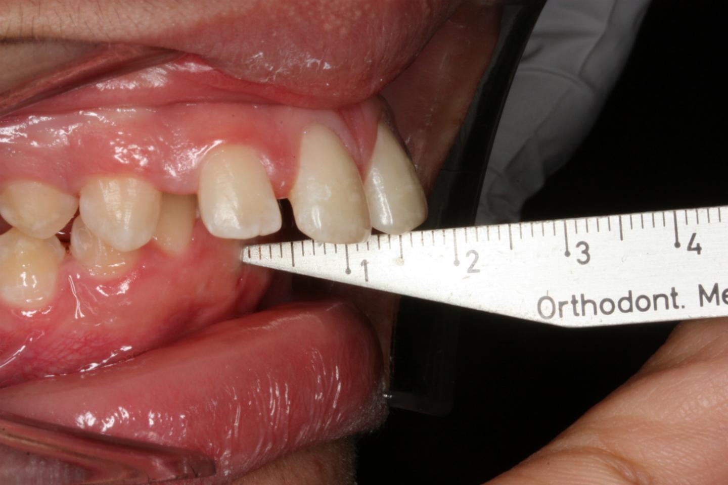 protect-protruding-teeth-from-damage-and-long-term-consequences