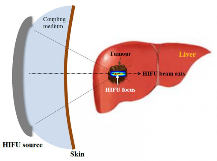 Destroying Cancer Cells With Non-surgical Ultrasound Treatment