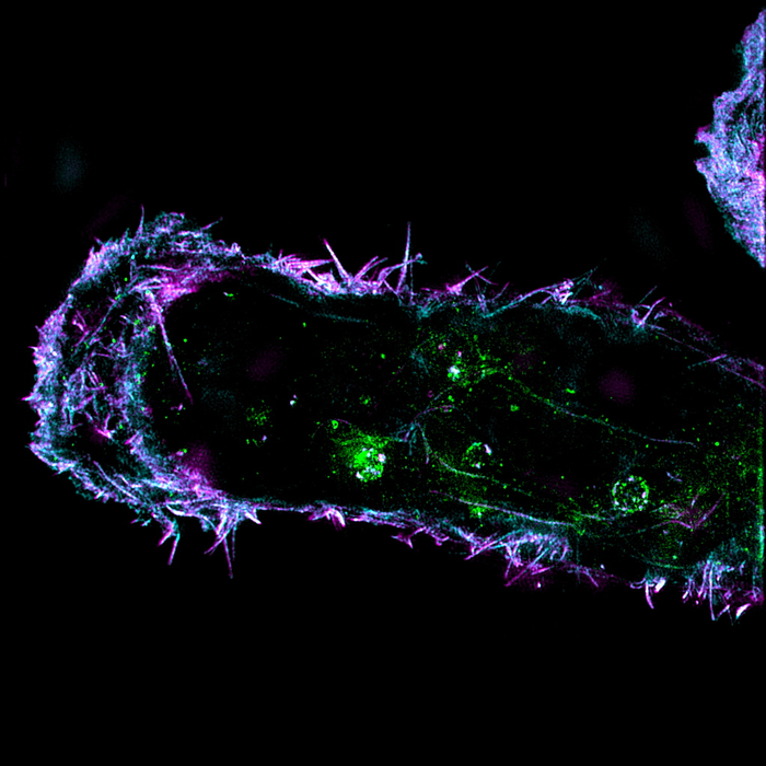 Malignant breast cancer cell