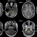 MR Images of Metastatic Tumor Reduction