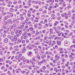 Image of an ovarian granulosa cell tumor