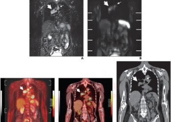 68-Year-Old Woman With Pathologically Diagnosed Small Cell Lung Cancer