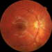 Macular Dystrophy Image