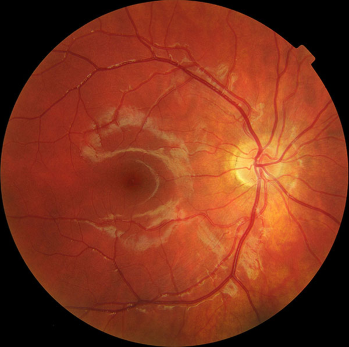 Macular Dystrophy Image