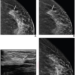 57-Year-Old Woman Presented for Screening Mammography