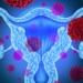 Uterine cancer illustration