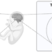 Origin and role of CLIP cells in Tuberous Sclerosis