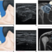 SWE in 37-Year-Old Man Awaiting Rotator Cuff Repair for Full-Thickness Supraspinatus Tendon Tear