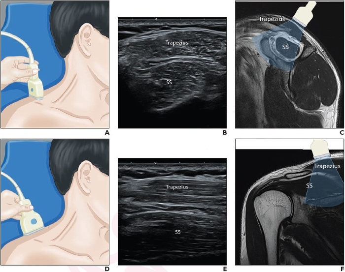 SWE in 37-Year-Old Man Awaiting Rotator Cuff Repair for Full-Thickness Supraspinatus Tendon Tear