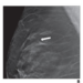 49-Year-Old Woman Presenting for Screening Mammography, Revealing Right Breast Architectural Distortion