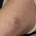 Merkel cell carcinoma lesion on left arm