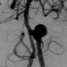 Image of an unruptured brain aneurysm