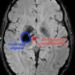 An MRI of a patient with a cavernous angioma