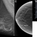 AI Shows Potential in Breast Cancer Screening Programs