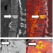 Iron accumulates in metastatic tumors