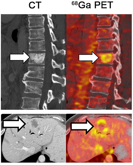 Iron accumulates in metastatic tumors