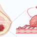 Overcoming resistance to breast cancer treatment