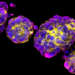 Breast Cancer Organoids