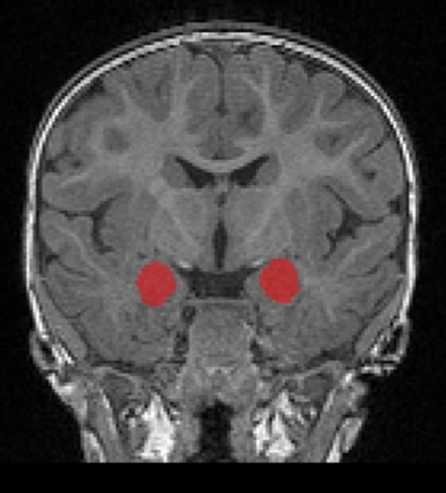 Scientists Identify Overgrowth Of Key Brain Structure In Babies Who Later