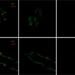 Confocal microscope study of p-syn deposits in a dermal arteriole of a patient with PD