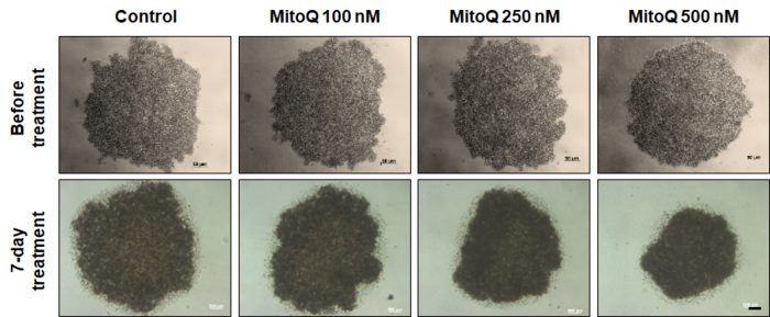 Drug prevents human breast cancer recurrence and metastasis