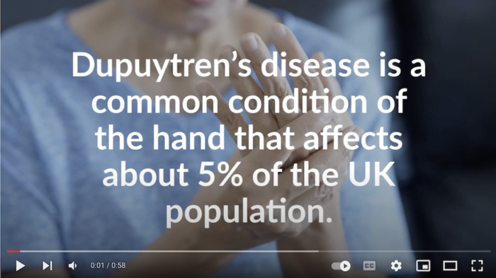 Dupuytren's research - results of the RIDD trial