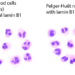 Blood cells with abnormal nuclei