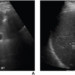 69-Year-Old Man With Chronic Hepatitis B