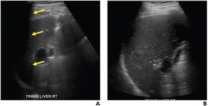 69-Year-Old Man With Chronic Hepatitis B