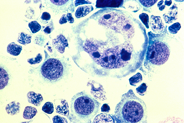 Lymphoma cells