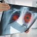 Lung cancer screening