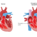 Image 1: Illustrates a normal valve versus tricuspid valve regurgitation