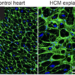 Muscle cells in a heart from a healthy person and a patiënt with hypertrophic cardiomyopathy