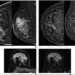 41-year-old woman with invasive ductal carcinoma (G2, luminal B) of right breast