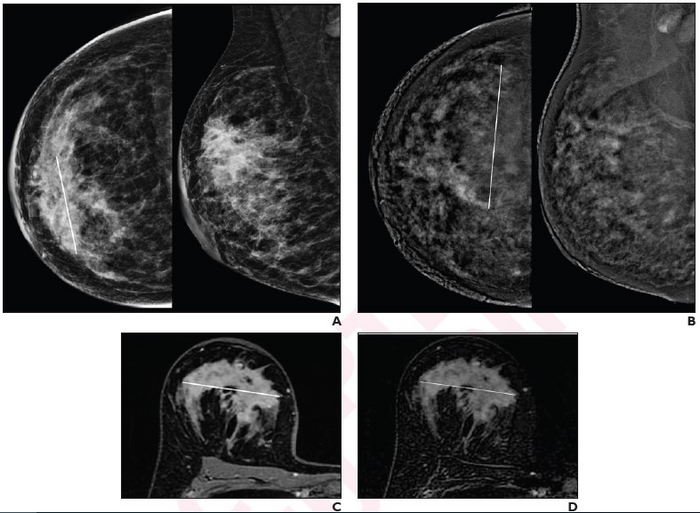 41-year-old woman with invasive ductal carcinoma (G2, luminal B) of right breast