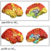 Brain Shrinkage in Anorexia